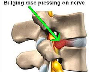 Herniated Disc