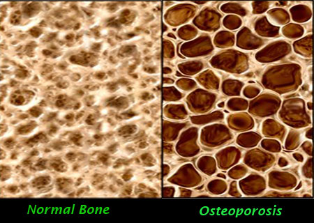 osteoporosis